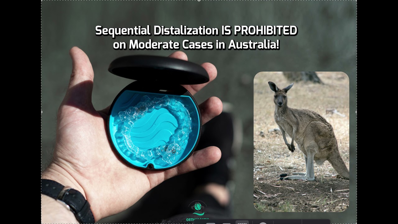Sequential Distalization BANNED by Invisalign on Moderate Cases in Australia