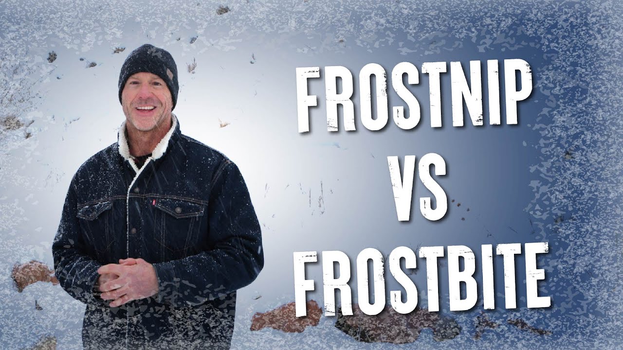 Frostbite Vs. Frostnip What's the difference?