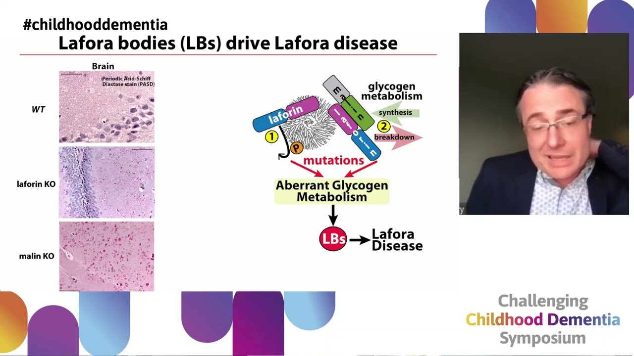 Pre-clinical treatments for Lafora disease - a childhood dementia driven by perturbed metabolism