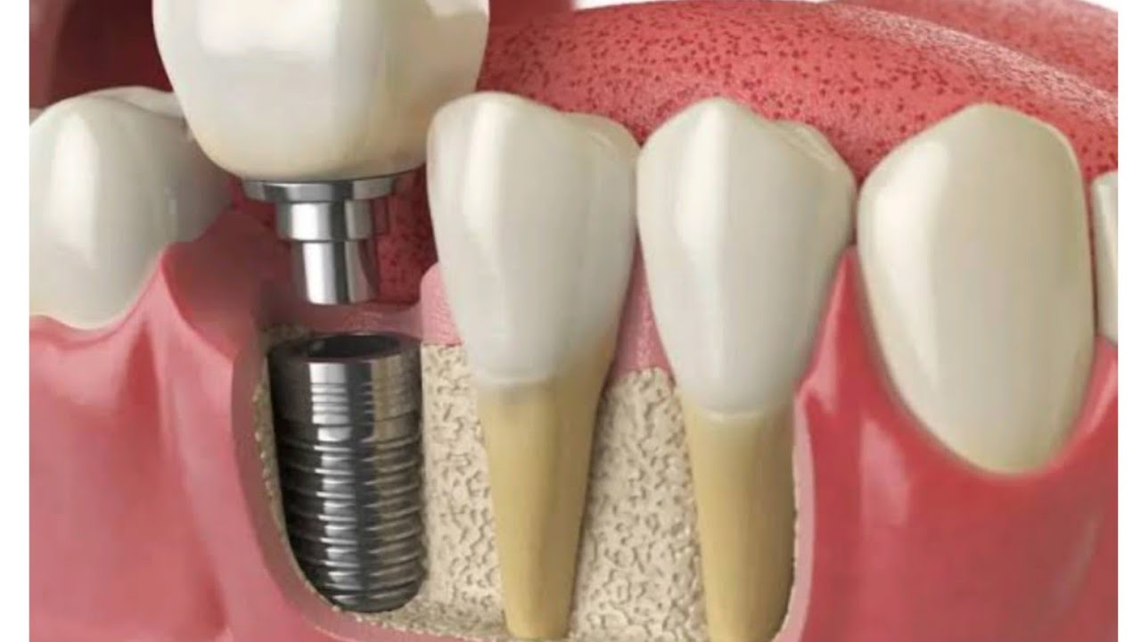 tooth vs smile /crowns vs bridges
