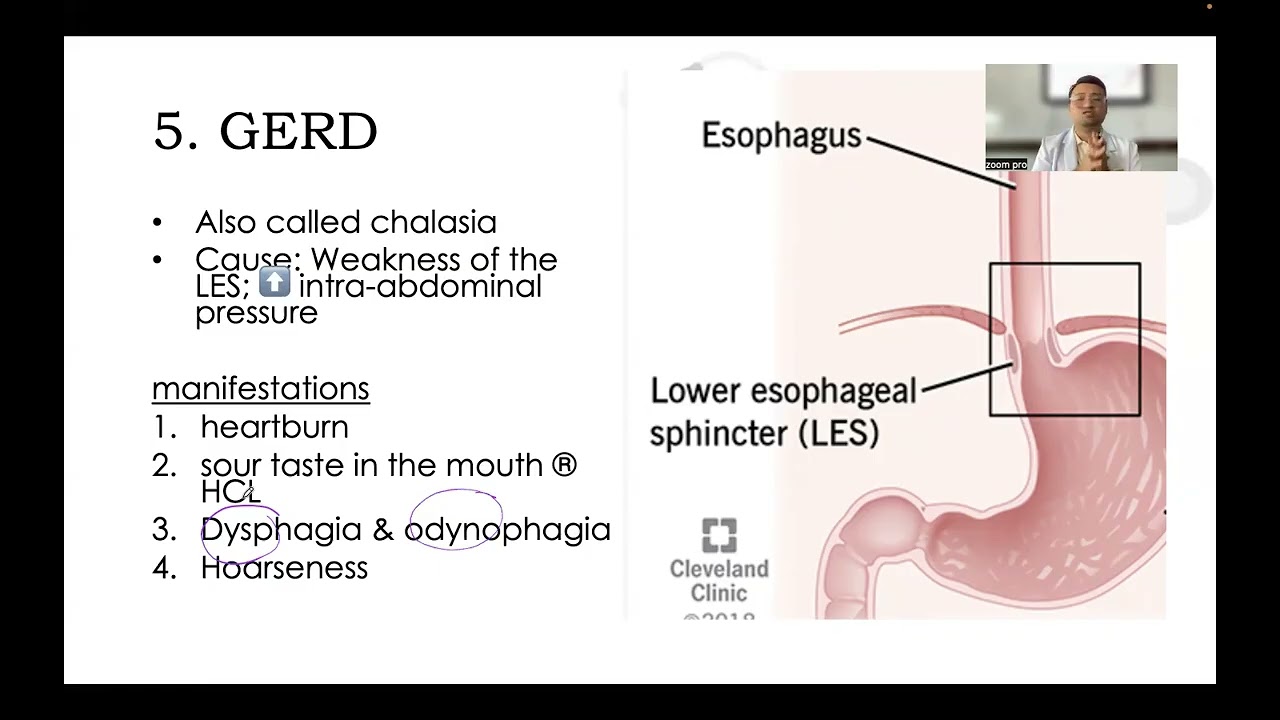 Gastroesophageal Reflux Disease (GERD) - MCN