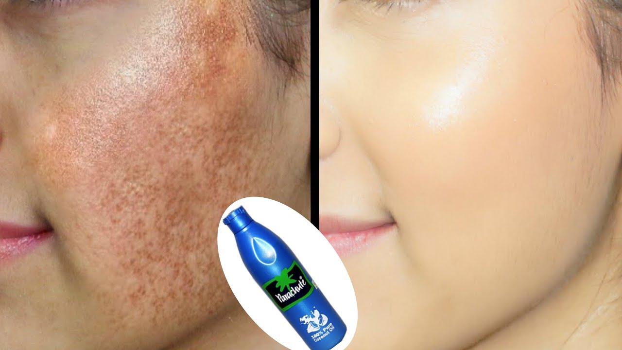 Coconut oil to remove pigmentation and dark spots |  Coconut oil for skin whitening