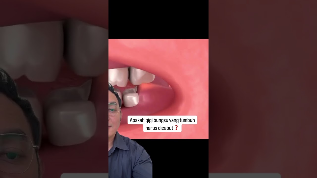 Menurut kalian gigi bungsu harus dicabut ? Video berikutnya aku kasih tau jawaban beserta alasanya