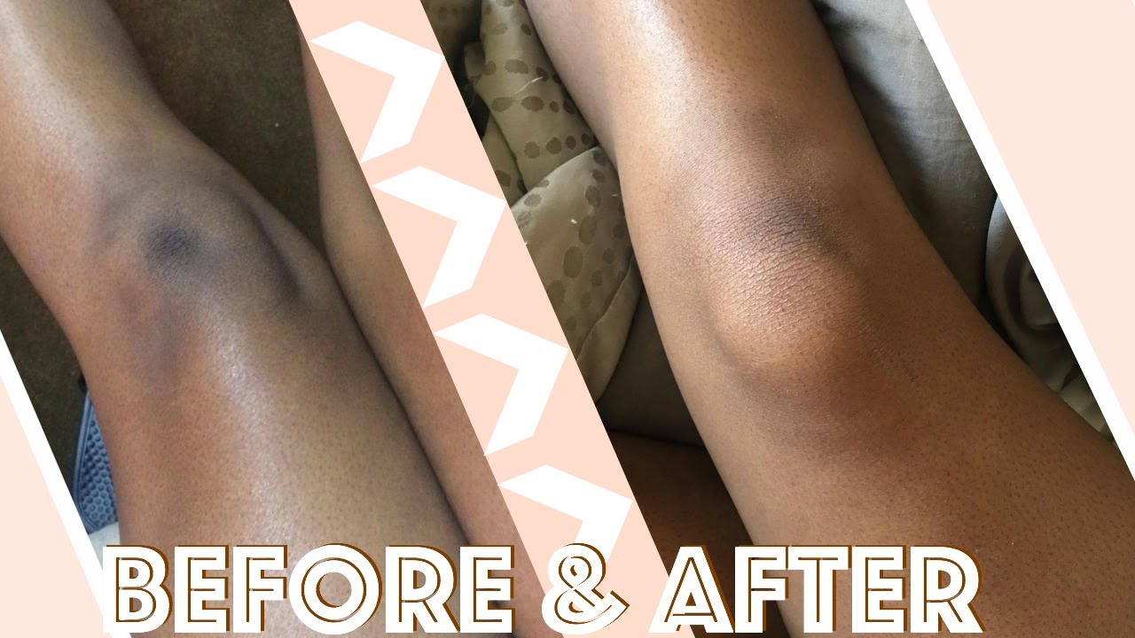 How I Lightened My Knees & Elbows In 2 Weeks | Fast & Cheap