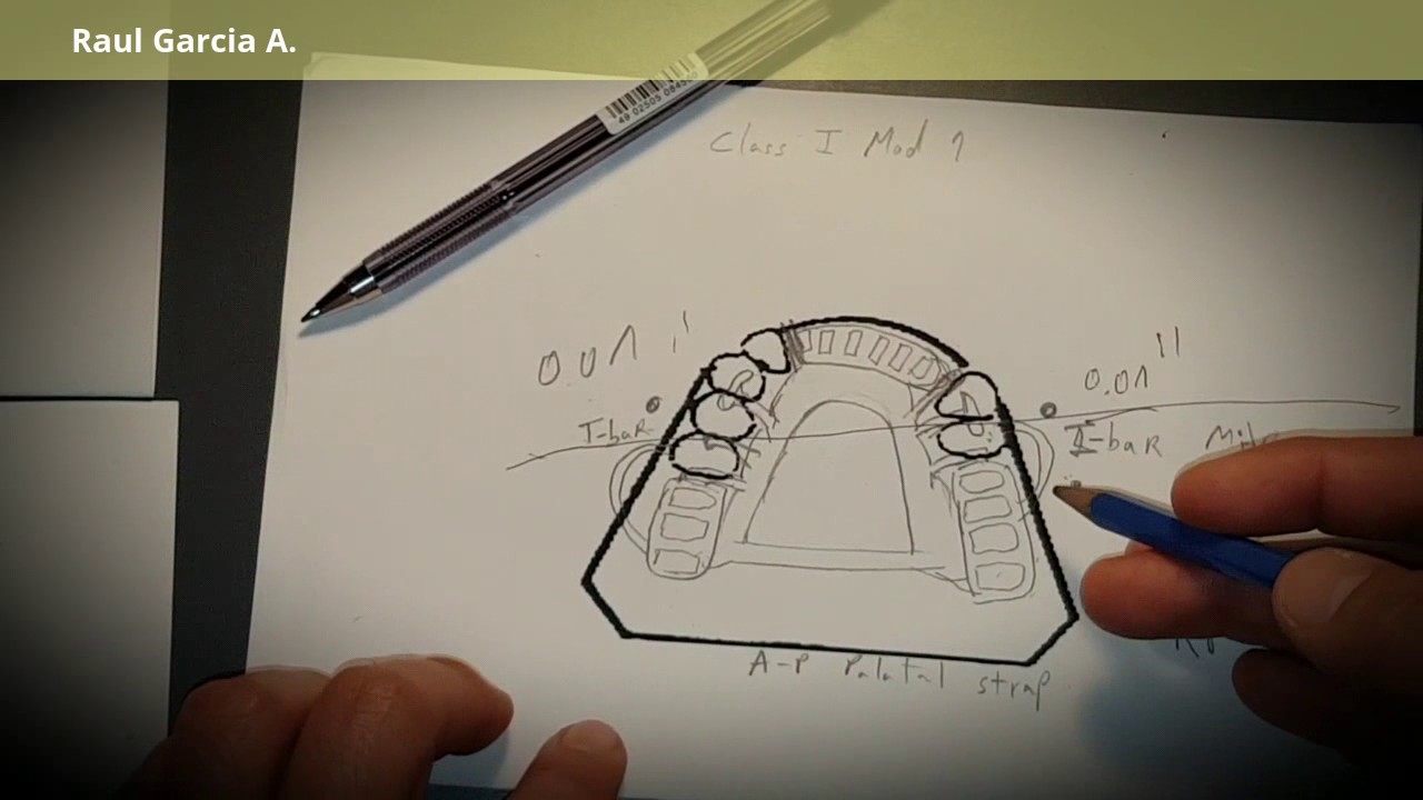 RPD video 3 - Class I kennedy design