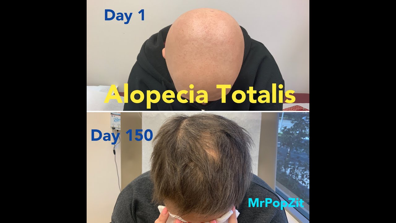 Alopecia Totalis- Devastating autoimmune hair loss. Reversed with topical Squaric Acid. MrPopZit
