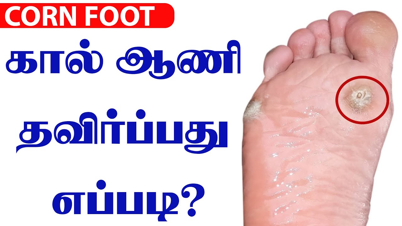கால் ஆணி (CORN FOOT)  தவிர்ப்பது எப்படி ?