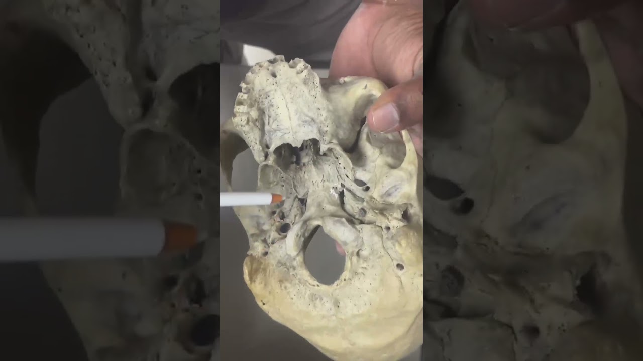 Normo basalis (Cranial nerves exiting foramens in Base of skull)