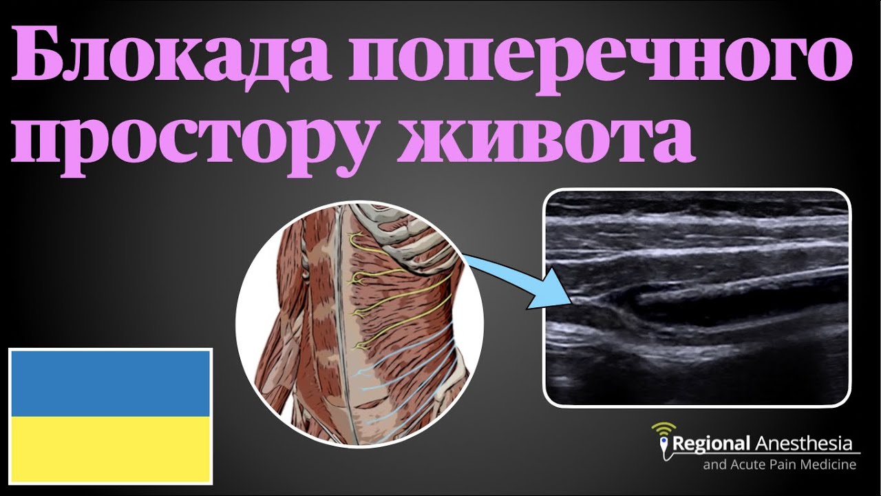 Блокада поперечного простору живота (TAP блокада) 🇺🇦 (Transversus abdominis plane [TAP] Block)
