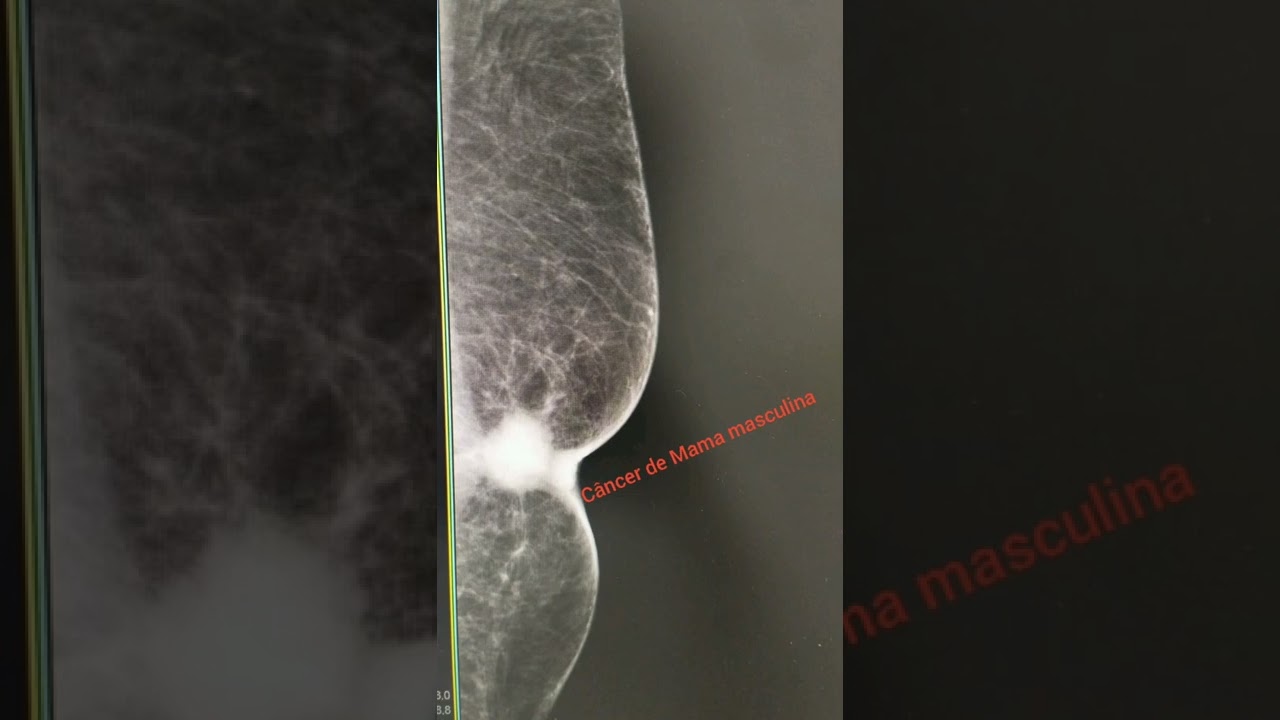 C.a de Mama masculina