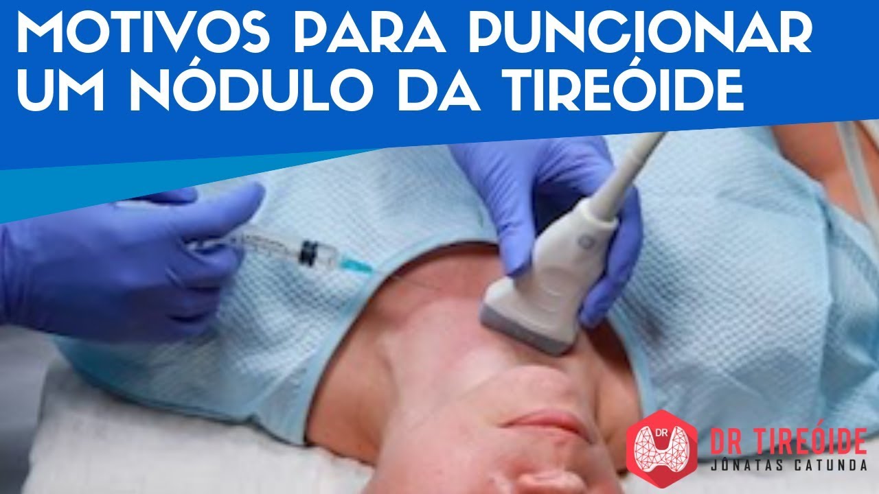 🔴Motivos para puncionar um nódulo da tireóide - Dr Tireóide Responde #49#