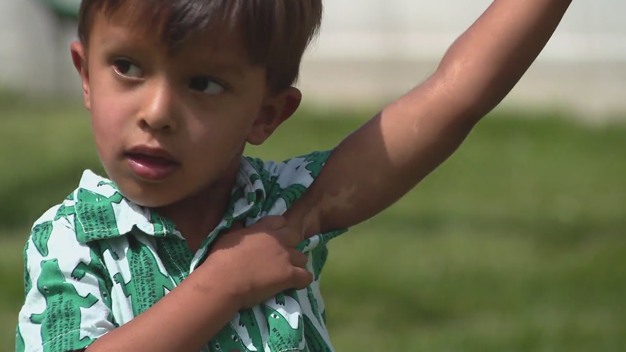 What looks like a birthmark could be a sign of a rare condition in children. But there's progress in