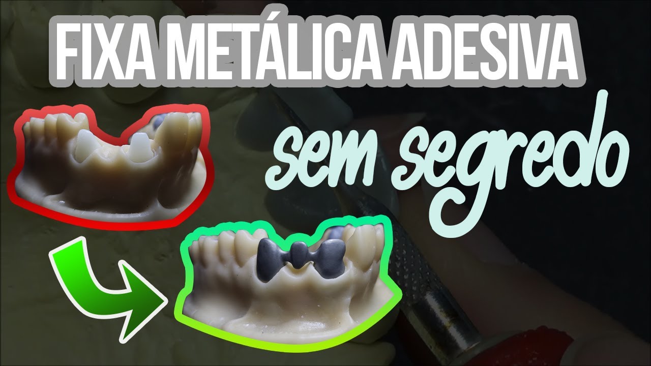 DO PROVISÓRIO À CERÂMICA Ep3 : Como fazer uma estrutura metálica adesiva (METALOCERÂMICA - 21/22/23)