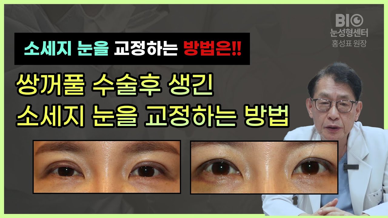 쌍꺼풀 수술후 생긴 소세지 눈을 교정하는 방법 - BIO성형외과 홍성표원장