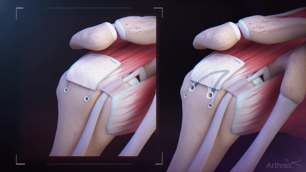 Система восстановления вращательной манжеты плеча CuffMend&trade;