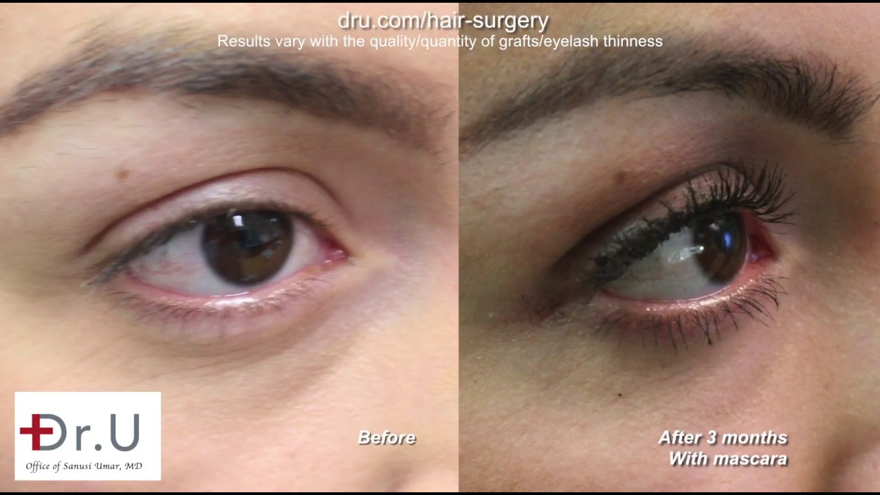 How Longer Eyelashes With Leg Hair Were Achieved For This Los Angeles Patient