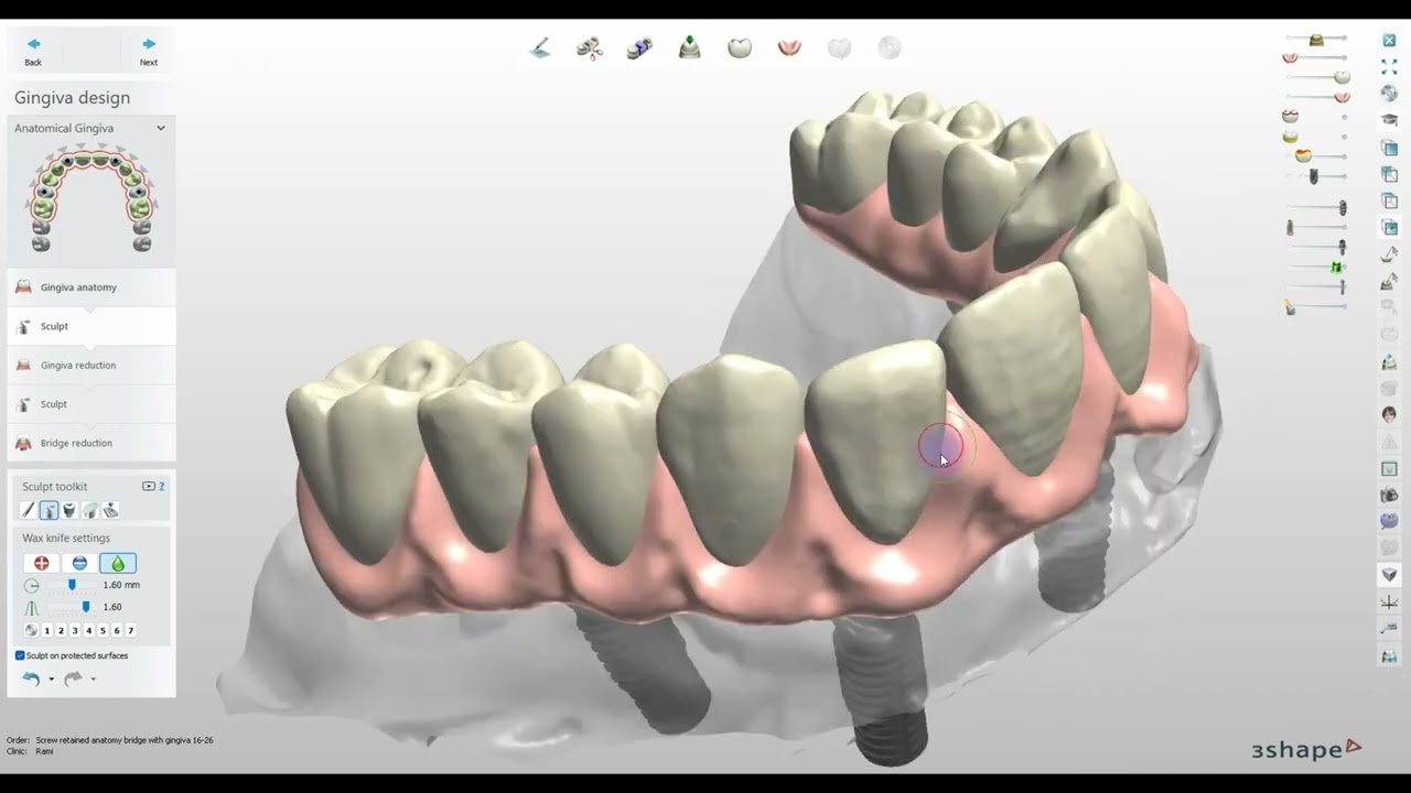 How to Design a Digital All on X Implants Bridge with the Thimble Crowns in 3Shape