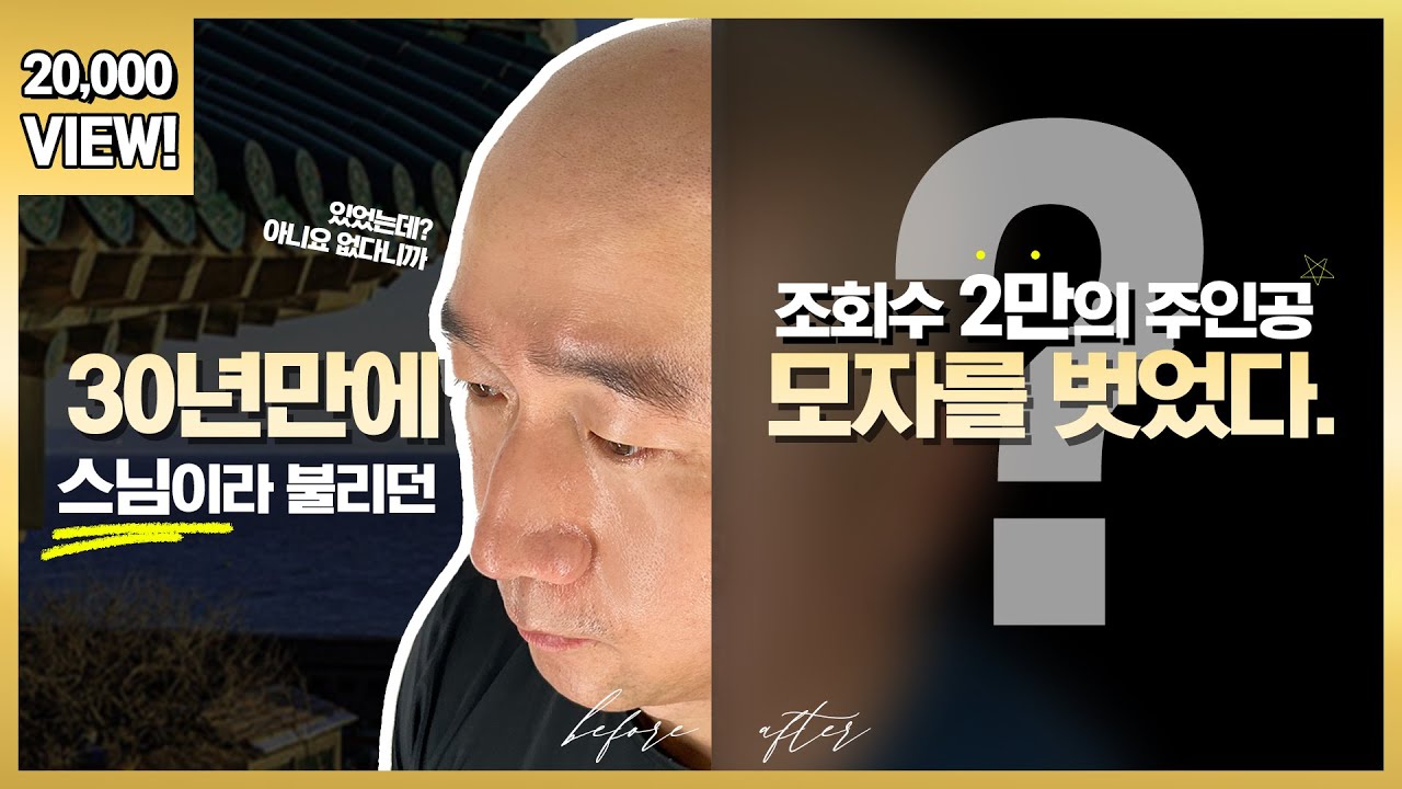 [탈터뷰] 탈모왕이 호언장담해서 믿고 받았는데...🥲 | 탈모왕두피문신TV