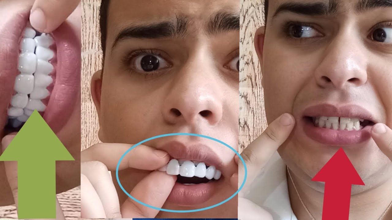 تجربة تركيب أسنان المشاهير بأرخص ثمن