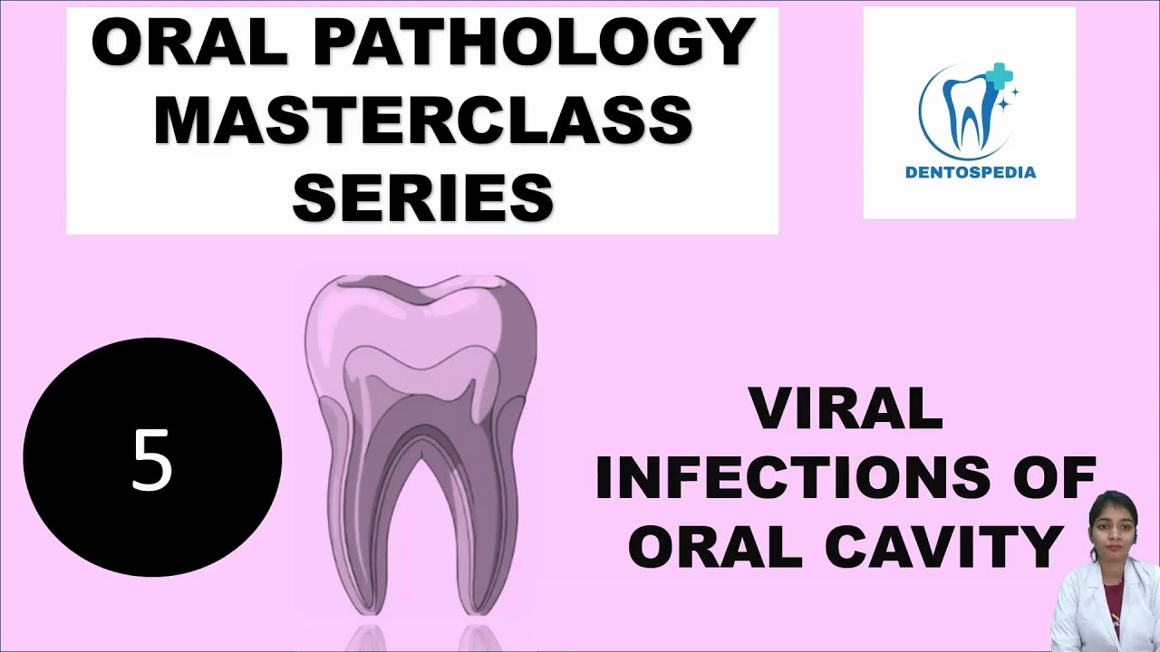 OP 5 Viral Infections of Oral Cavity Explained | Oral Pathology #oralpatho #oralpathology #afk #ore