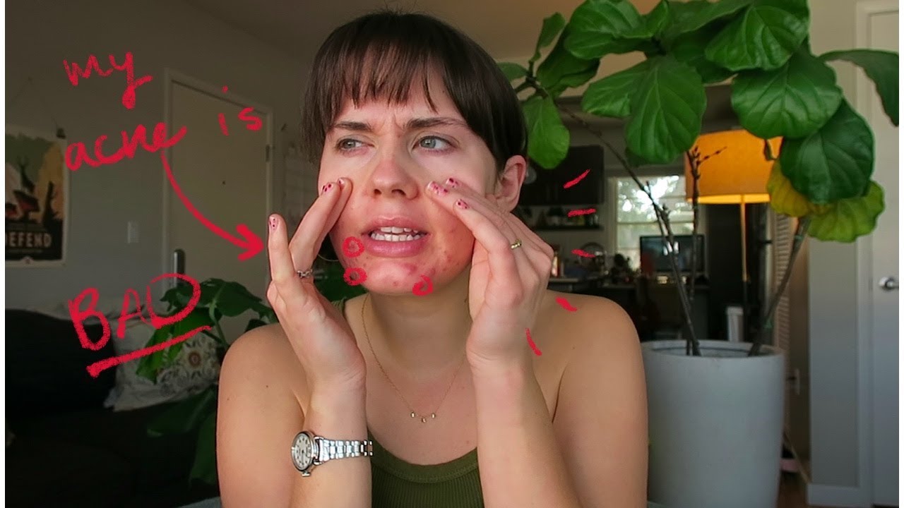 my skin has never been this bad...