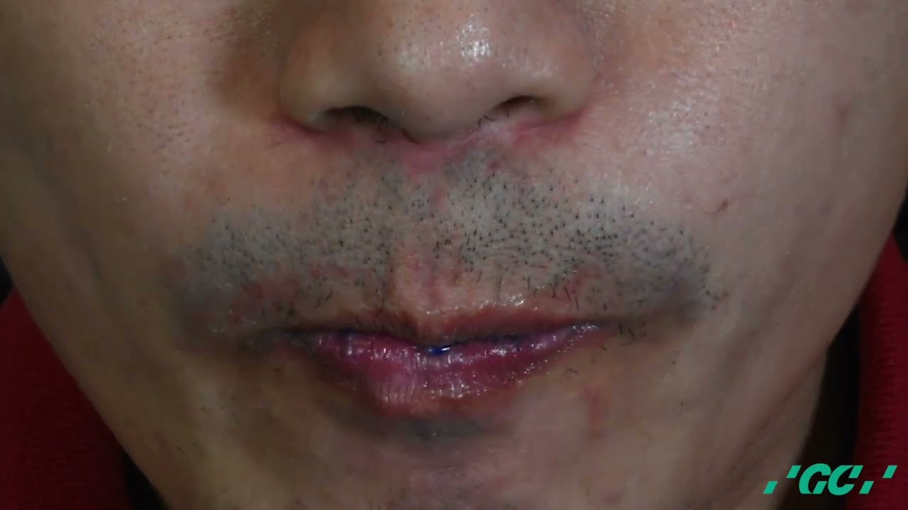 GC Tri Plaque ID Gel
