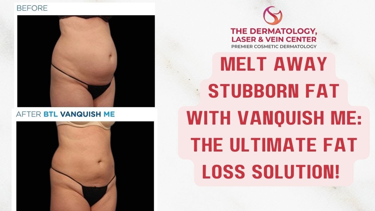The Revolutionary Way to Shed Pounds: Vanquish ME Explained! #fatloss #bodycontouring #cosmeticderm