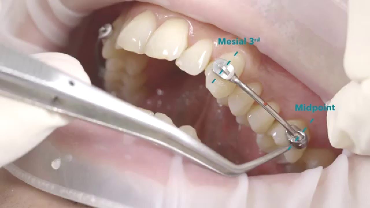 Carriere&reg; Motion&trade;  Class II Appliance Placement Video