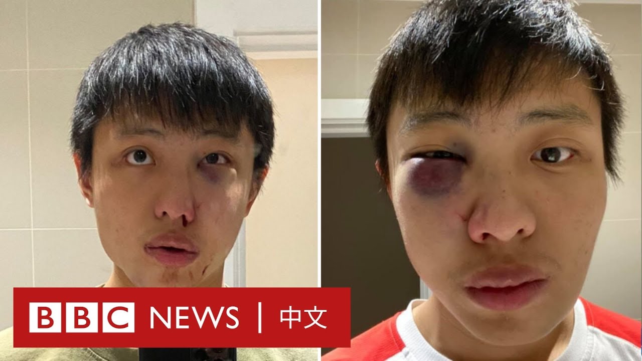 新冠肺炎：亞裔留學生受歧視 倫敦街頭被毆打－ BBC News 中文