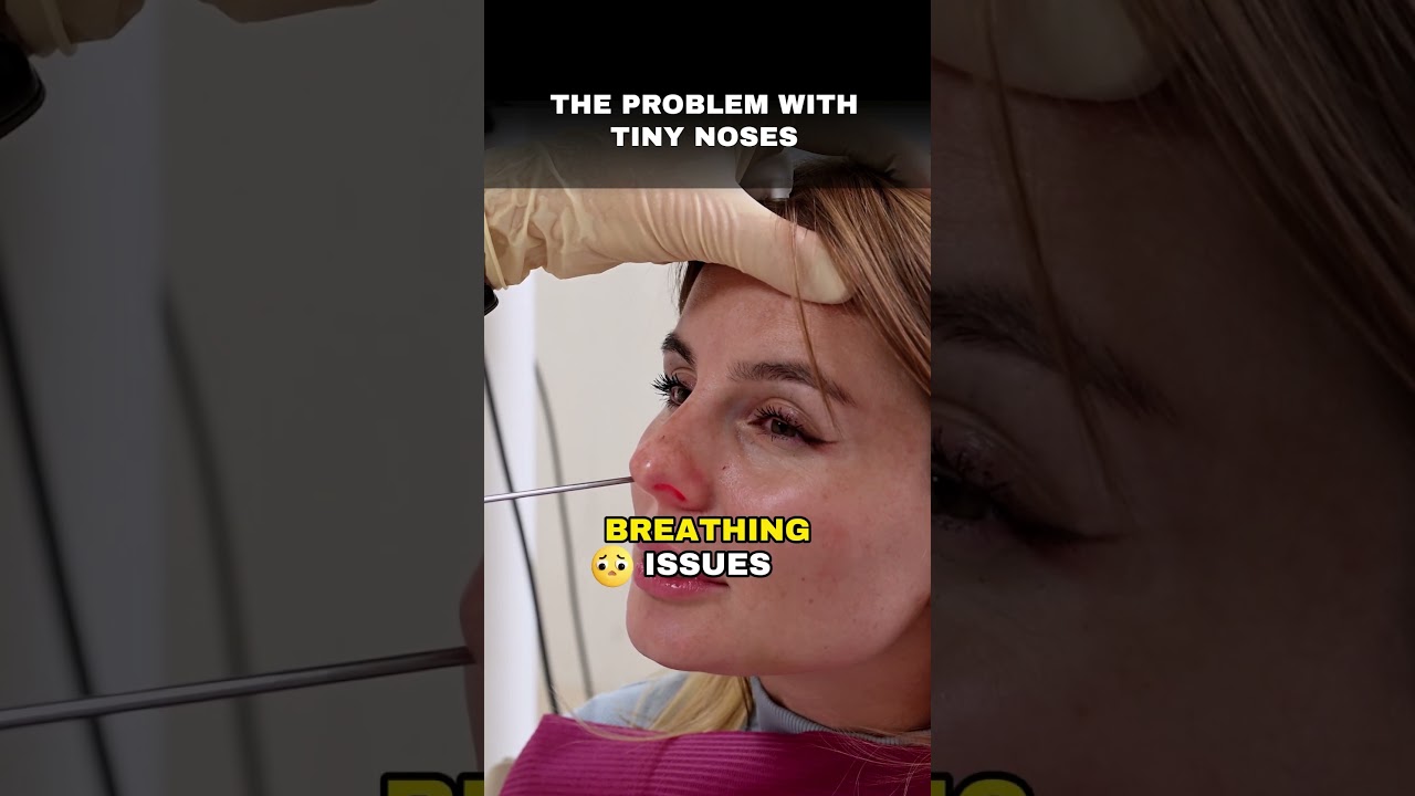 The Problem with Barbie Nose #plasticsurgery #plasticsurgeryrevision #barbienose #smallnose