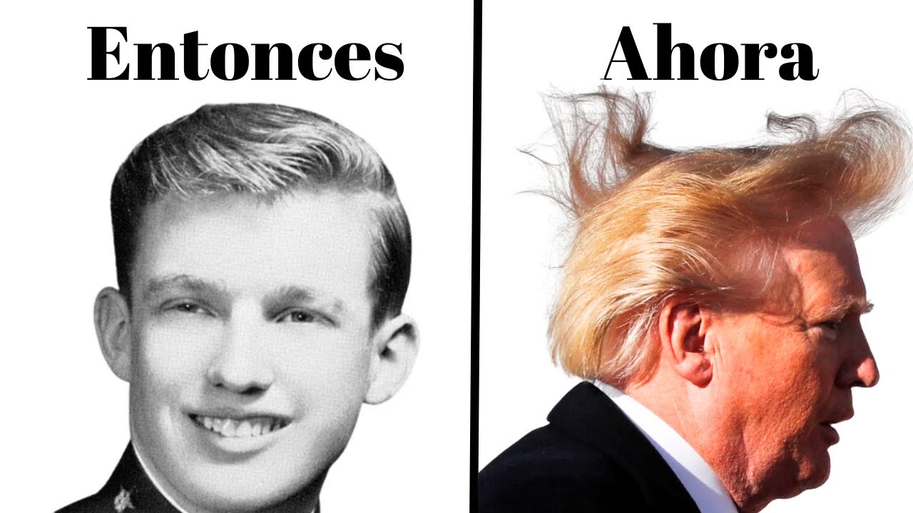El Trasplante de Cabello de Donald Trump | El Cirujano Capilar Reacciona