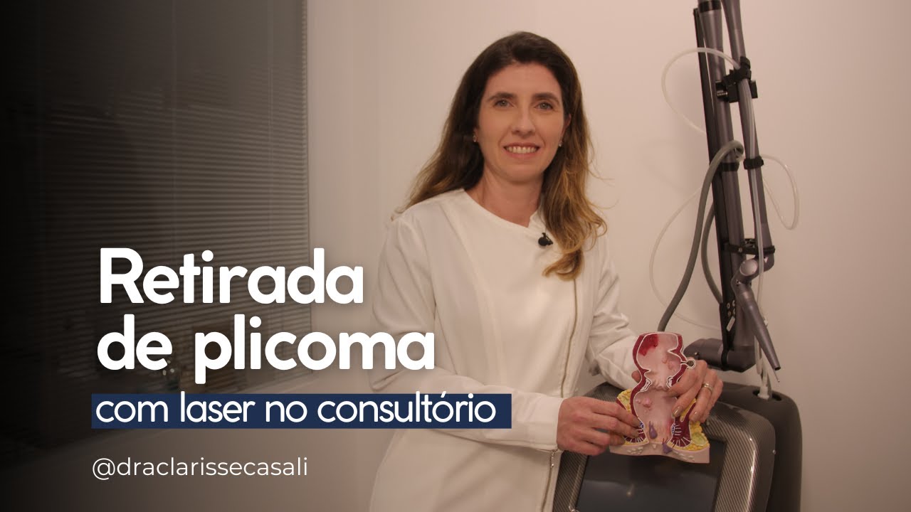 Retirada de plicoma com laser no consultório