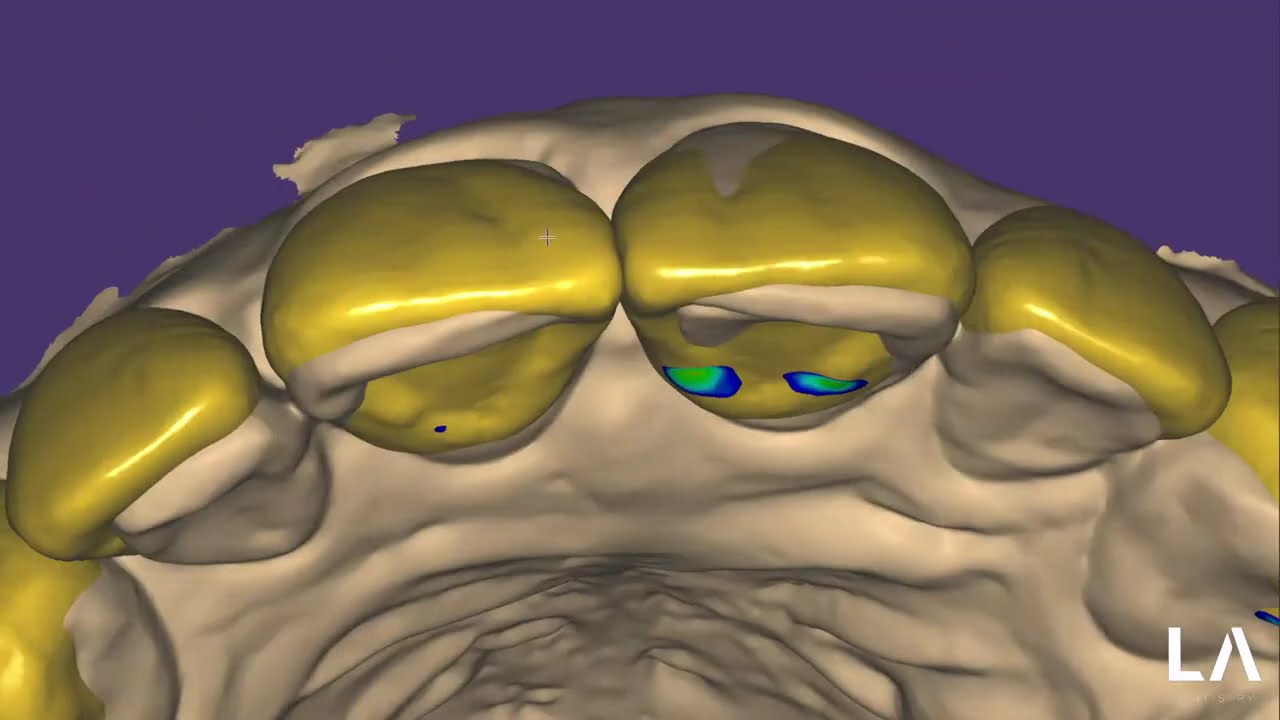 Digital Wax Up in EXOCAD