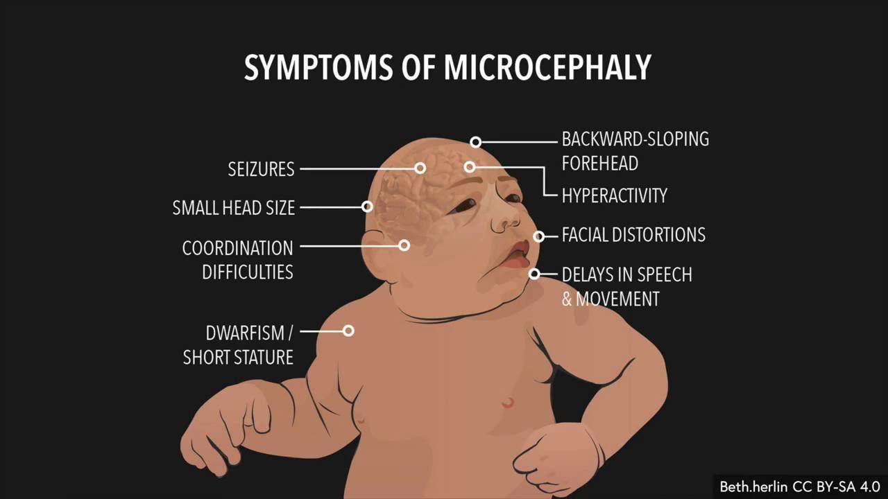 Microcephaly and congenital Zika syndrome (1.6)