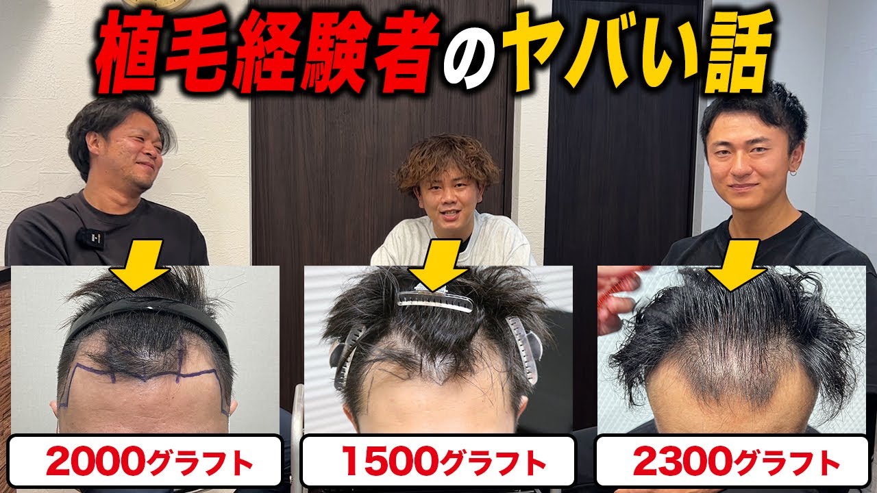 【30代薄毛】植毛経験者が語るヤバい話がおもしろすぎるwww