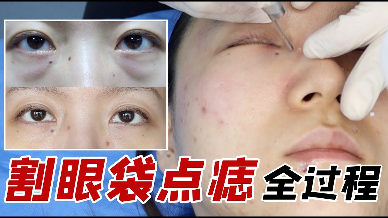 割眼袋、点痣全记录！鬼知道我经历了什么？！