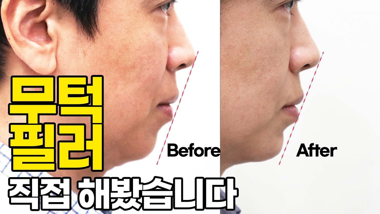 무턱 필러 직접 해봤습니다. 레스틸렌 필러로 무턱 필러 수술없이 턱 만들기! 무턱 필러 효과 비교까지!