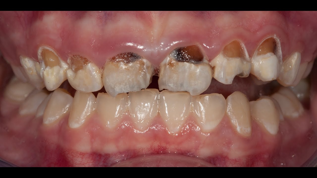 Restoring A Smile In One Visit w/ CADCAM Robotic Dentistry! *Beautiful Smile*