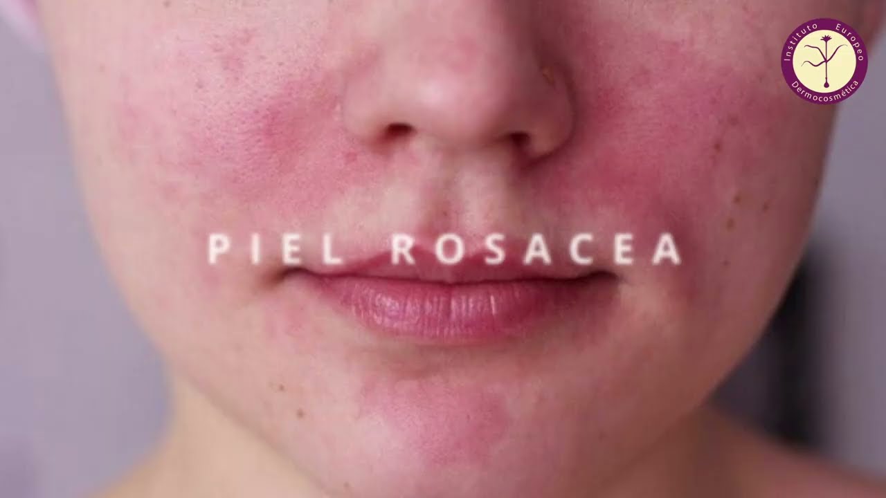 La piel rosácea en cosmética natural - Ejemplo de una Masterclass del Instituto de Dermocosmética