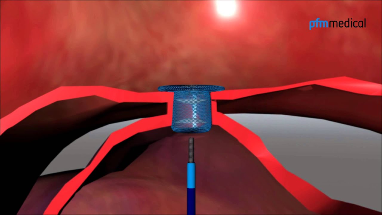 Nit Occlud PDA R Video