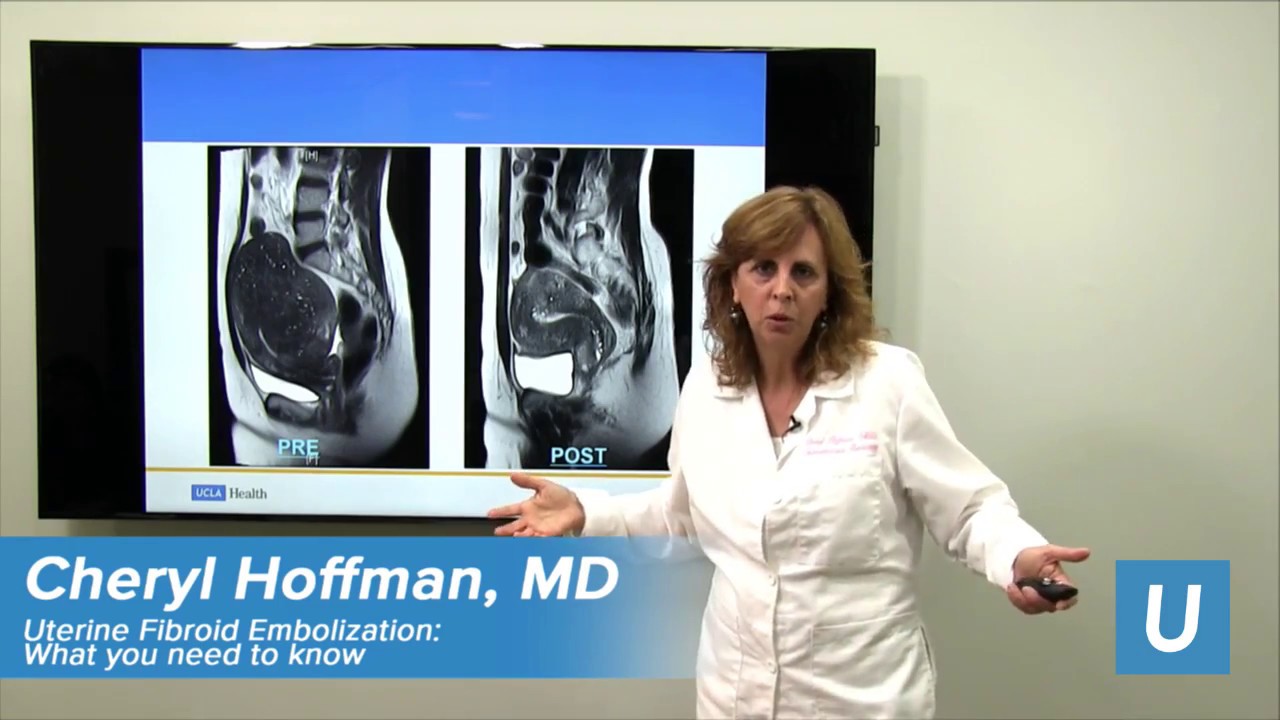 Uterine Fibroid Embolization | Cheryl Hoffman, MD | UCLAMDChat
