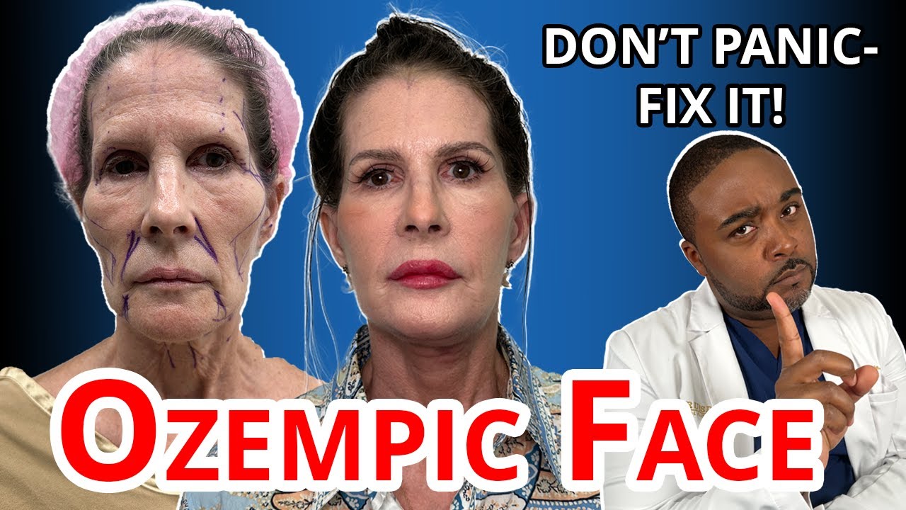 😳 Ozempic Face?! Why It Happens & How to FIX It—Doctor Truesdale Explains!