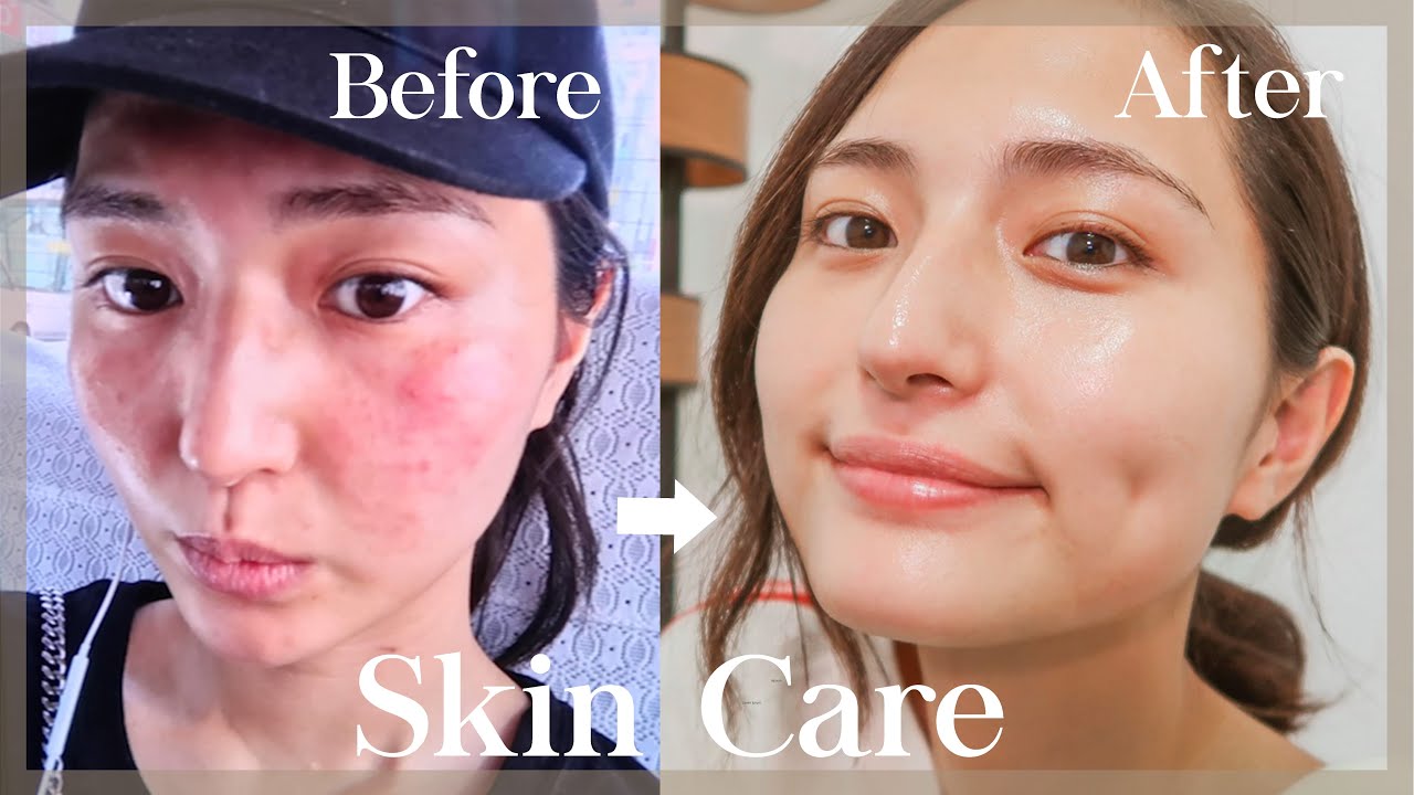 【激変】私が肌荒れ改善した方法！ツヤ肌を維持する今のスキンケア【実体験】