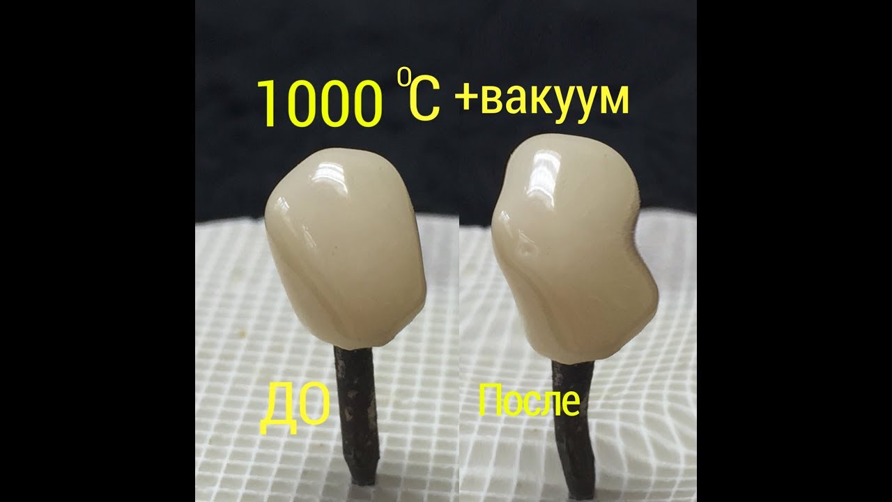 Что случится с керамической коронкой после  обжига на1000 градусов . Зубной техник. Видео курс. BAOT