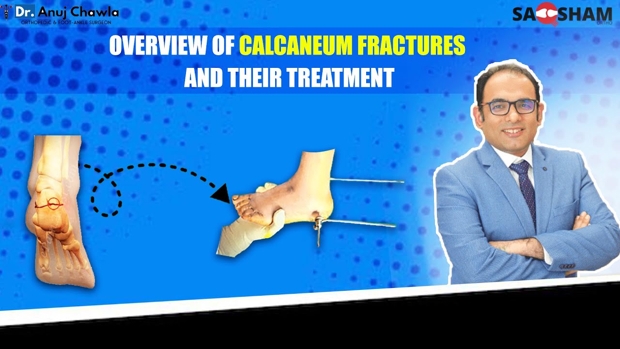 Understanding Calcaneum Fractures: Causes, Symptoms, and Treatment Options
