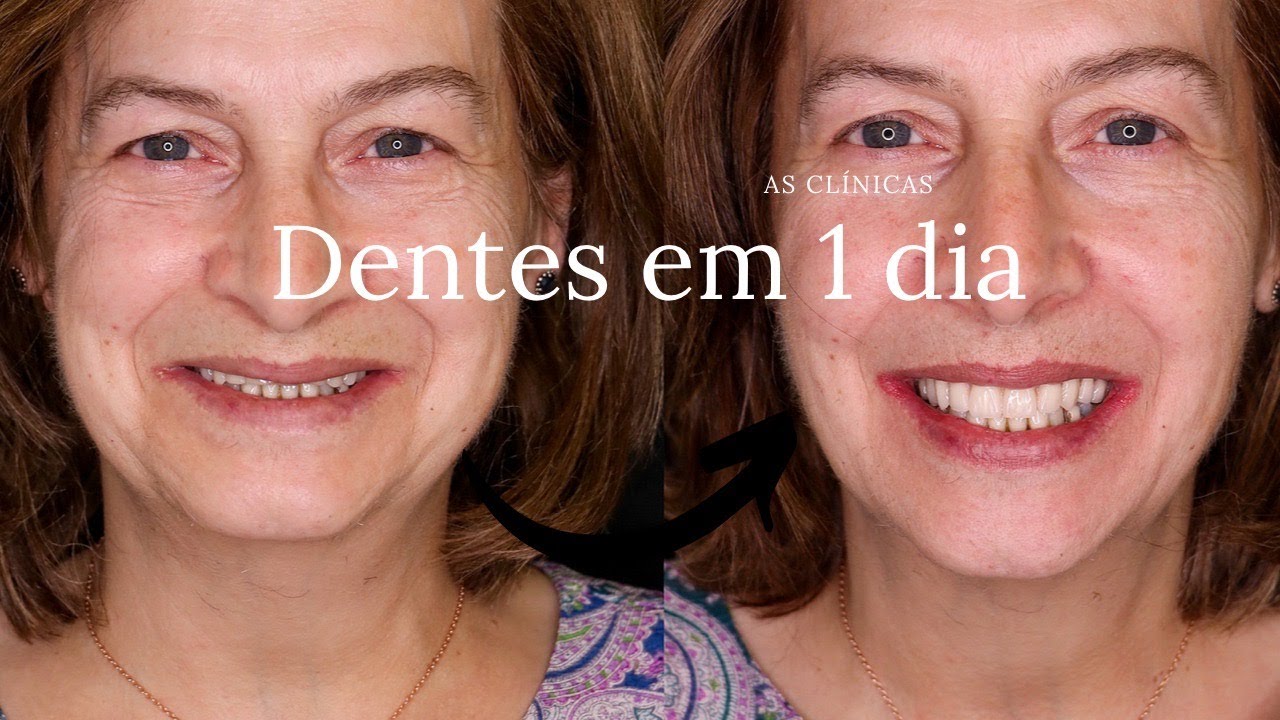 Dentes em 1 dia | Implantes Dent&aacute;rios | Carga imediata | AS CL&Iacute;NICAS