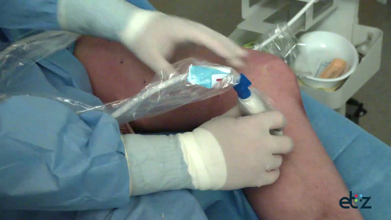 Spataderbehandeling met laser: EVLT