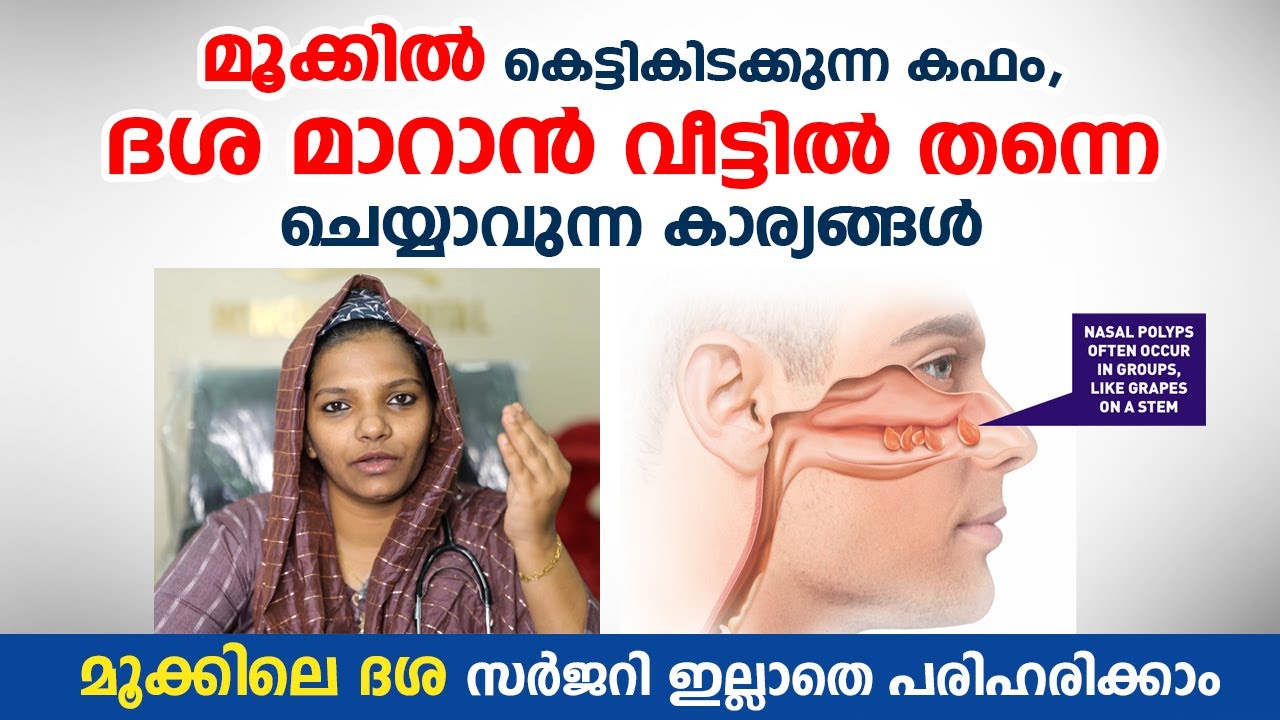 മൂക്കിൽ കെട്ടികിടക്കുന്ന കഫം ദശ മാറാൻ വീട്ടിൽ ചെയ്യാവുന്ന കാര്യങ്ങൾ | Nasal Polyp | mookile dasha