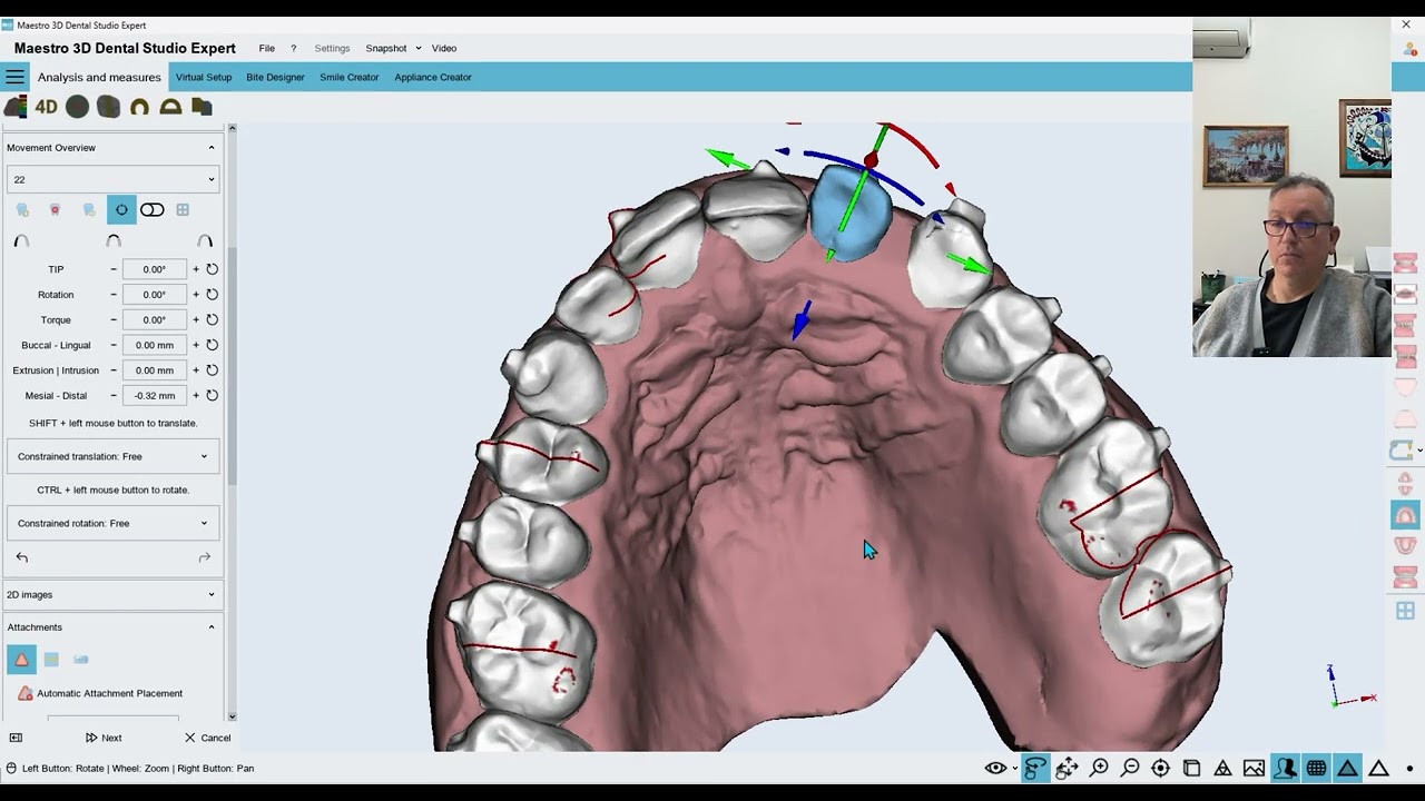 Maestro 3D Dental Studyo expert ,in-house  Aligners and DIY solutions Part 6 Distalization Class 2 C