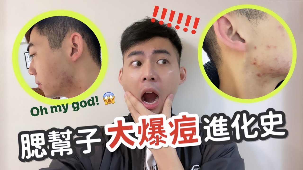 腮幫子「大爆痘」之超崩潰皮膚進化史｜恐怖到不敢見人｜如何找出皮膚痘痘問題？😨 | Daniel Hsu 丹尼爾